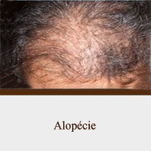Alopécie